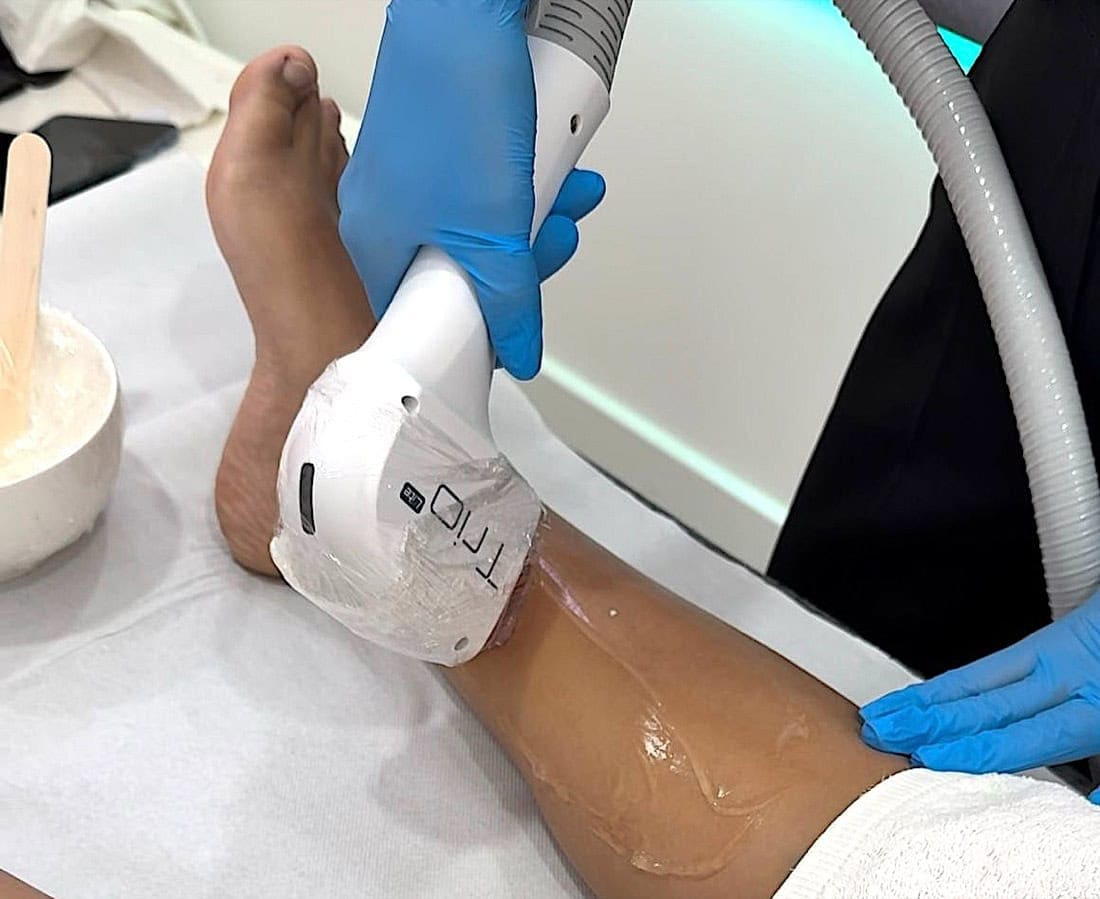 Promo Epilazione Laser Bergamo 3